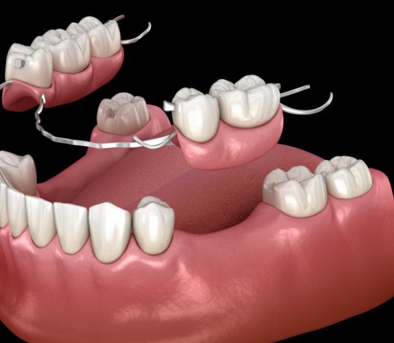 Understanding Dentures, dental prosthetics, oral prosthesis, dentition, removable dental appliances, denture technology, artificial teeth, custommade dentures, oral restoration, dental solutions, denture fitting, oral function, denture care, tooth replacement, oral health, dental wellness, denture wearers, dental experts, dental evaluation, oral wellbeing, denture maintenance, dental appliances, denture stability, dental consultation, denture materials